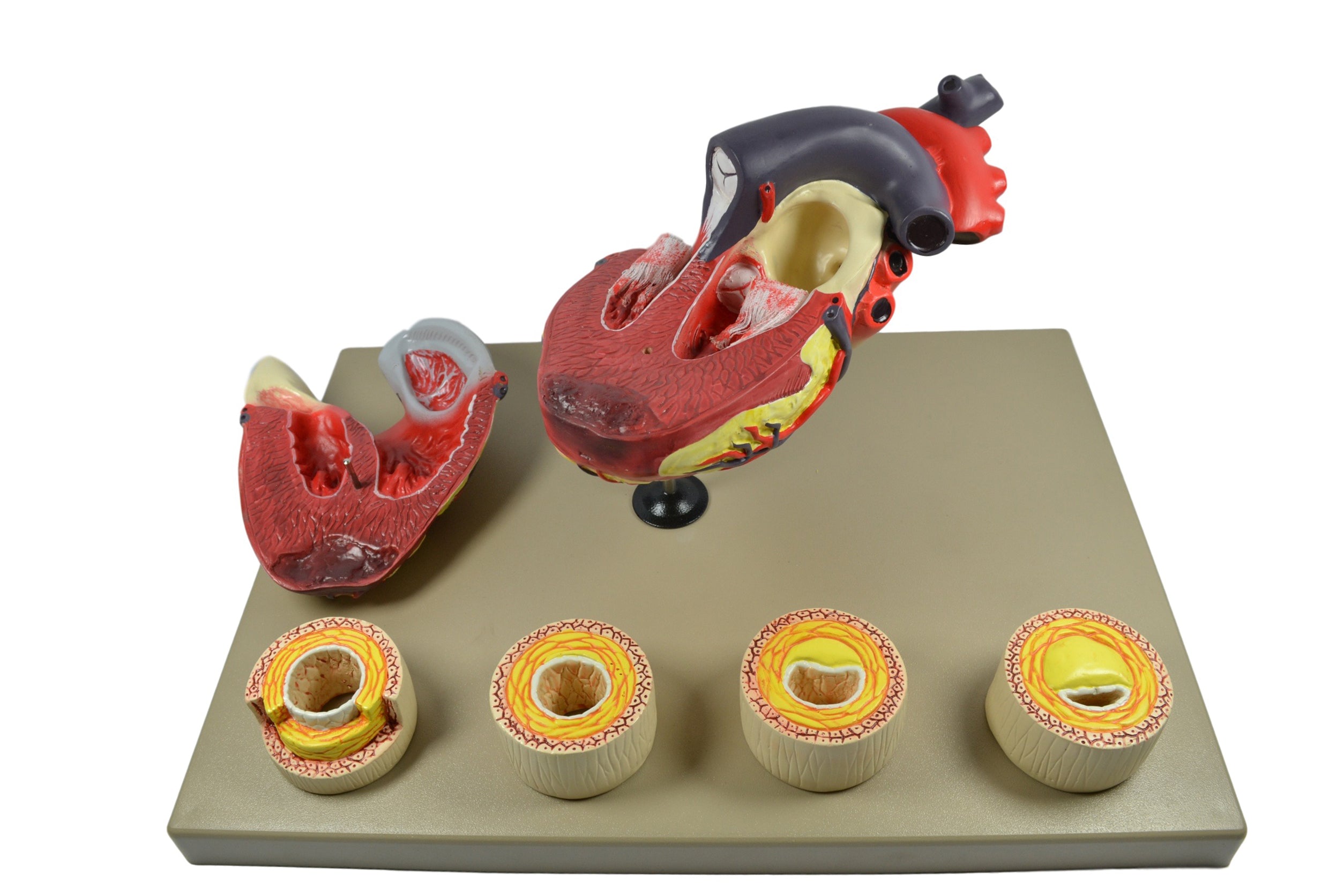 Human Heart Conditions Pathology Model with Artery Cross-Sections, 10"