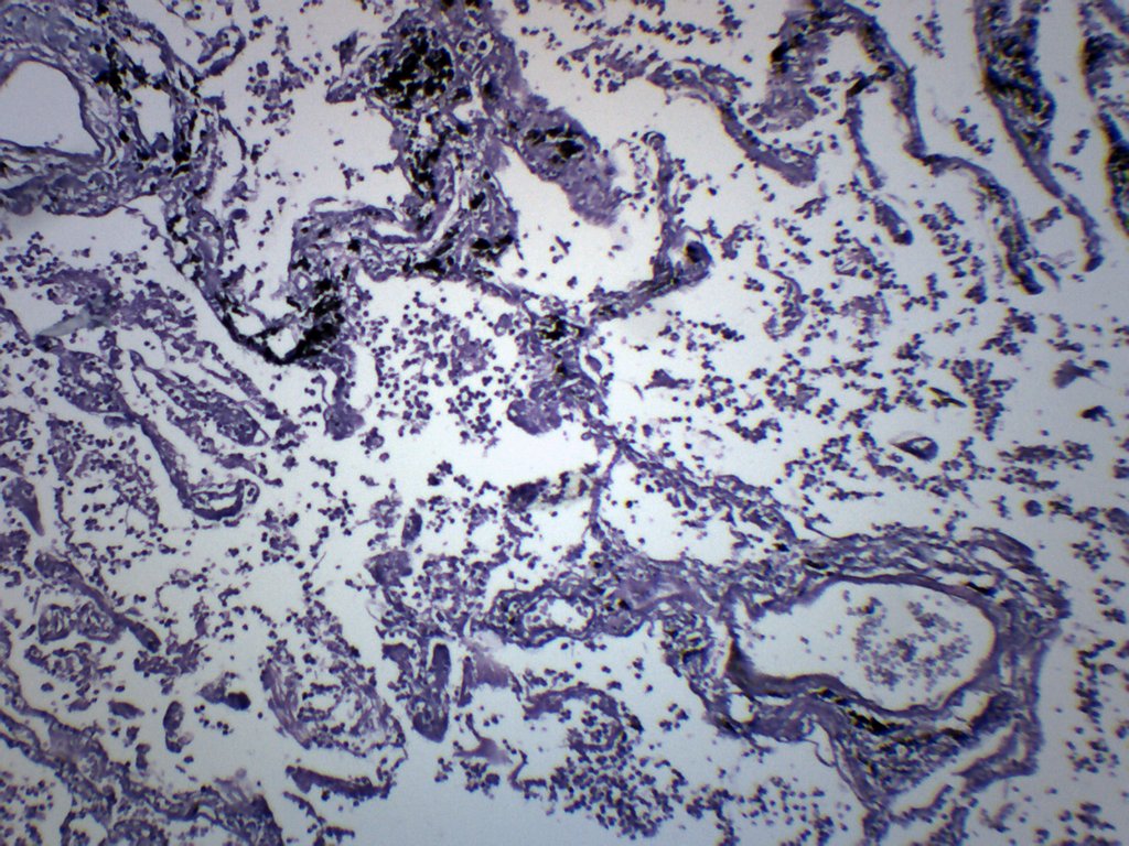 Pneumonia in Human Lungs Prepared Microscope Slide