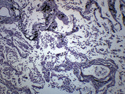 Pneumonia in Human Lungs Prepared Microscope Slide