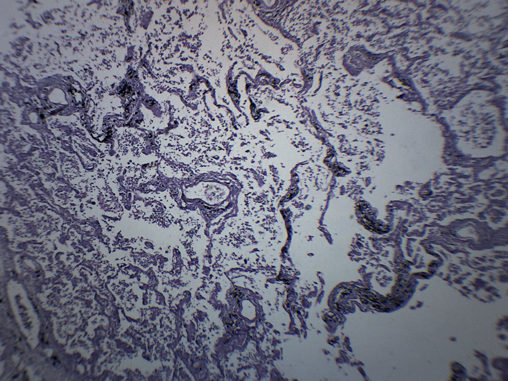 Pneumonia in Human Lungs Prepared Microscope Slide