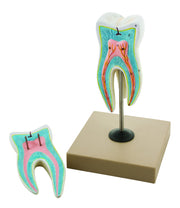 Upper Triple Root Molar Model with Caries, 15X Enlarged, 2-Part