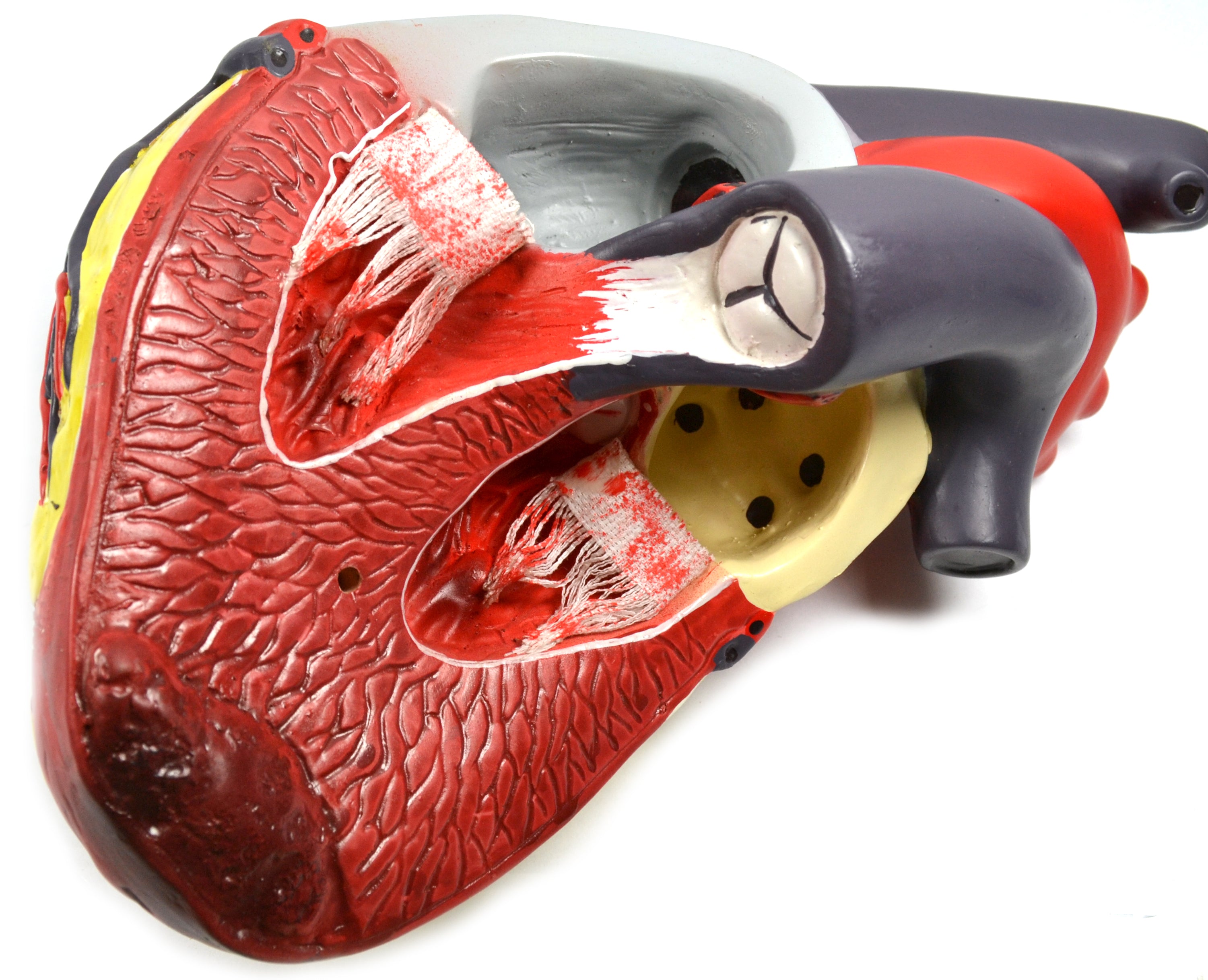 Human Heart Conditions Pathology Model with Artery Cross-Sections, 10"