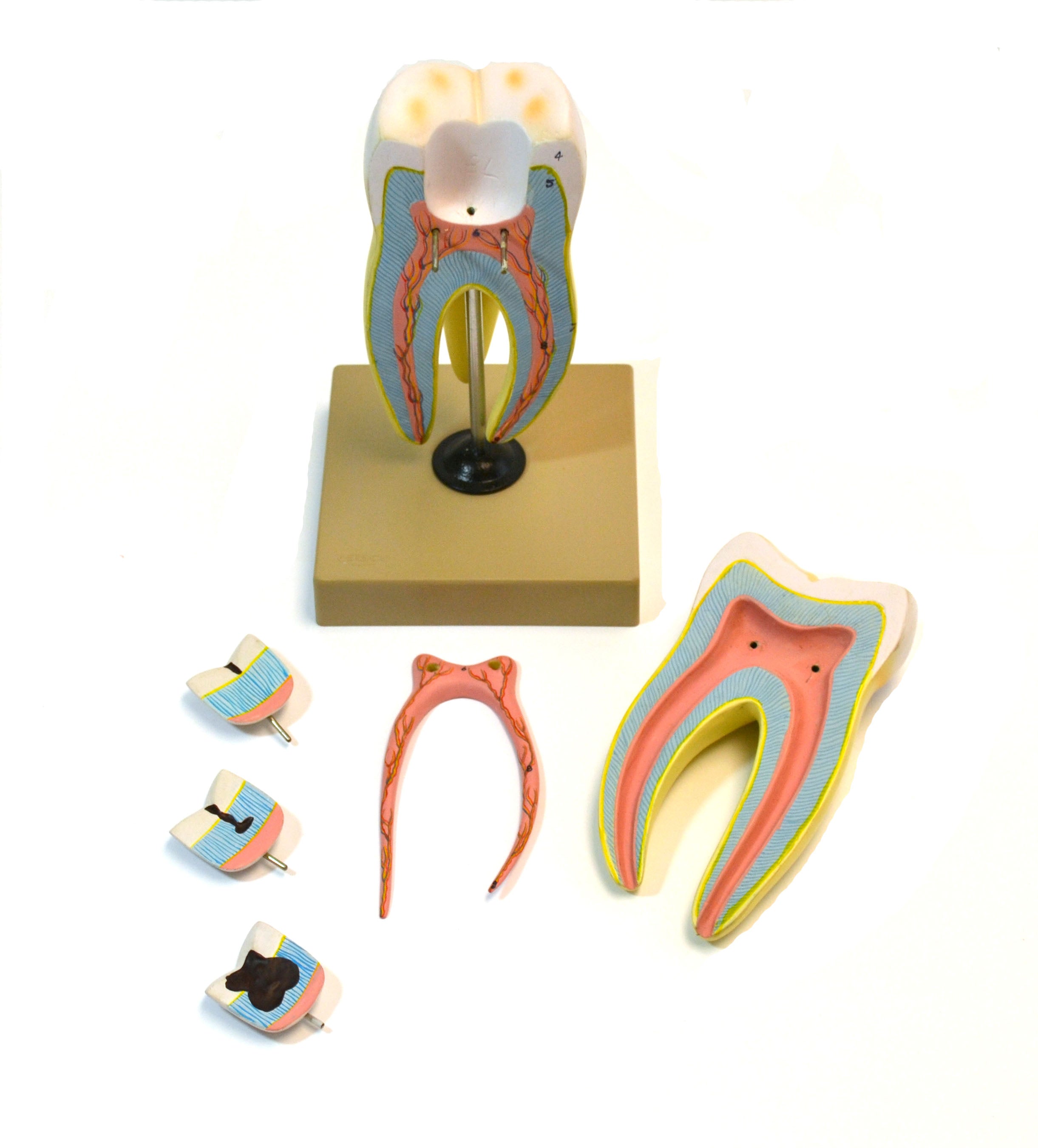 Upper Triple Root Molar Model with Interchangeable Cavities, 6-Part