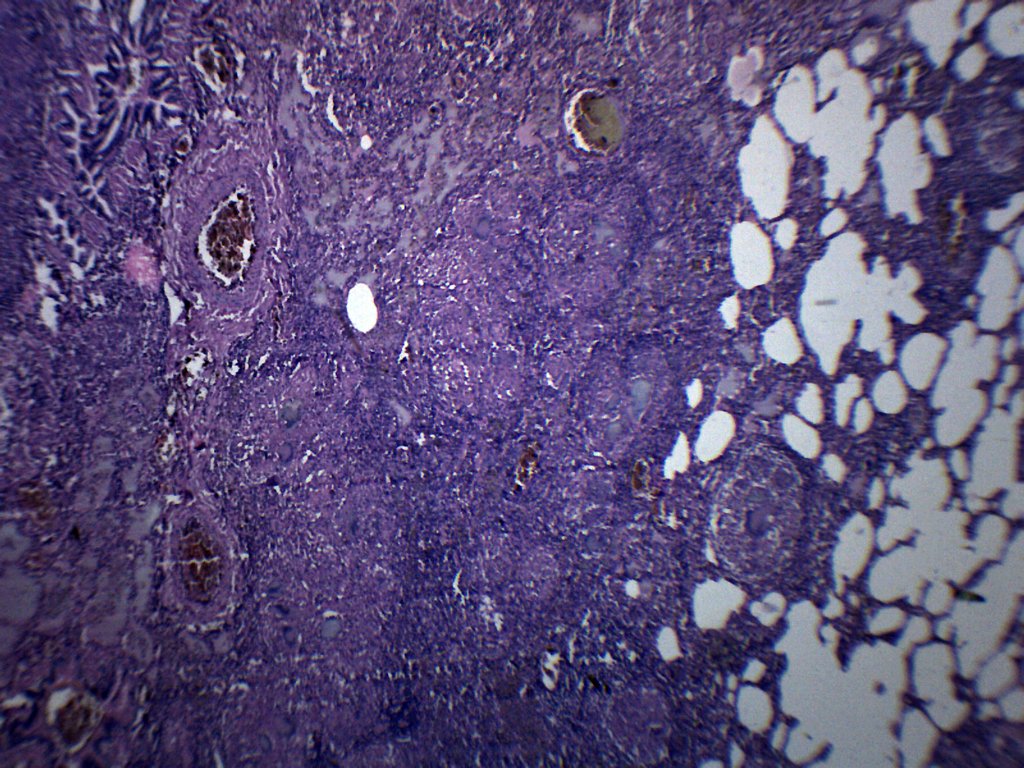 Tuberculosis Human Lung Section Prepared Microscope Slide