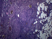 Tuberculosis Human Lung Section Prepared Microscope Slide