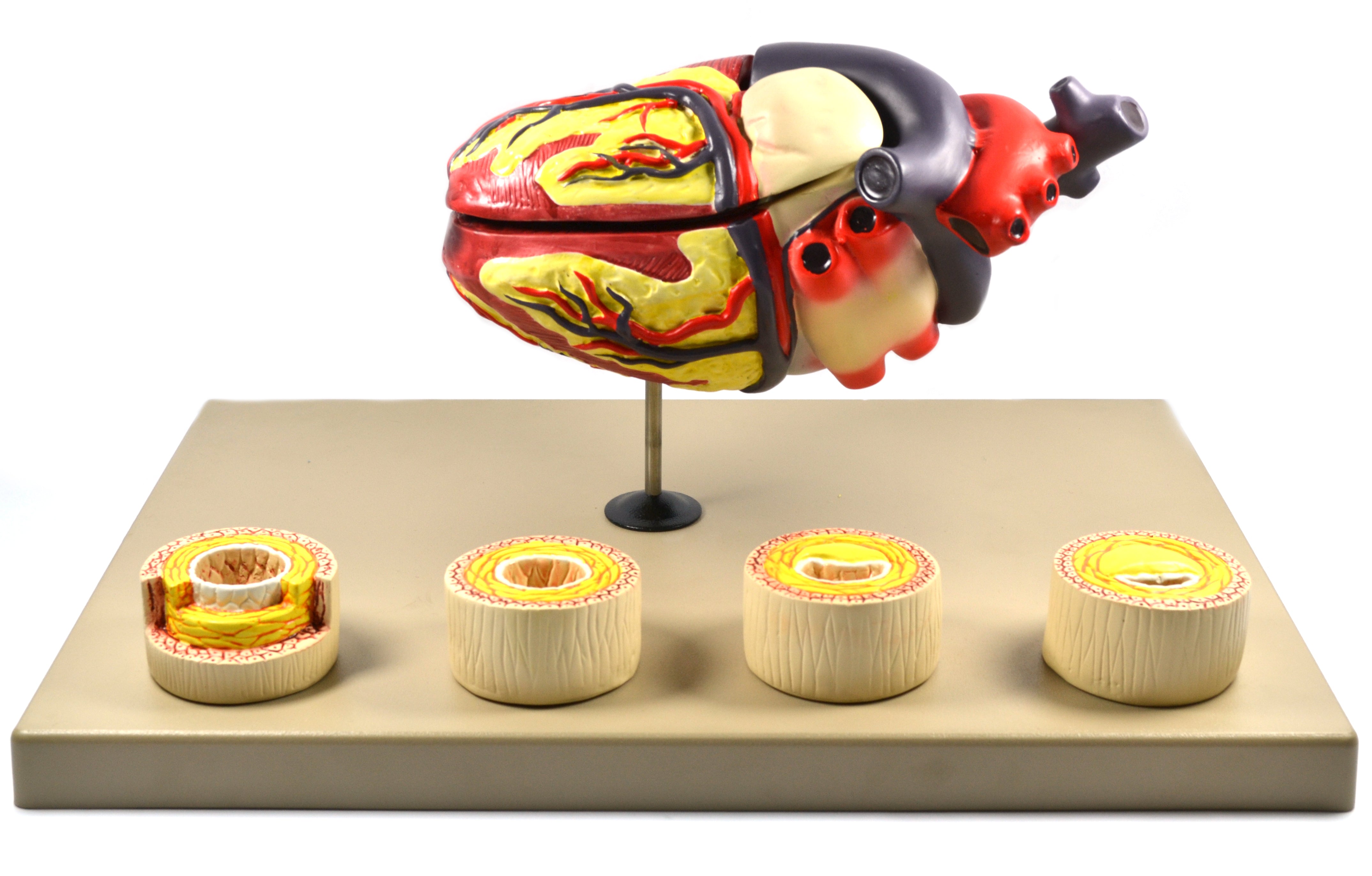 Human Heart Conditions Pathology Model with Artery Cross-Sections, 10"